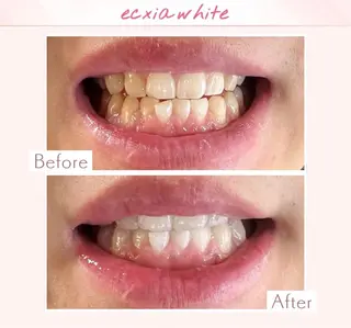 エクシアホワイト調布所属・umi❤︎ ホワイトニングのその他イメージ