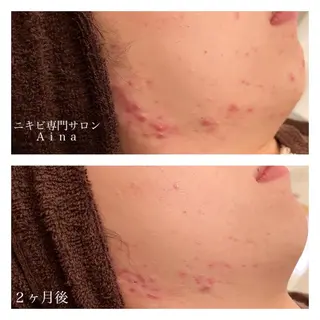 セミロング カラー パーマ ヘアアレンジ メンズ キッズ ネイル マツエク・マツパ ニキビ跡専門サロン Ａｉｎａのエステ・リラクイメージ