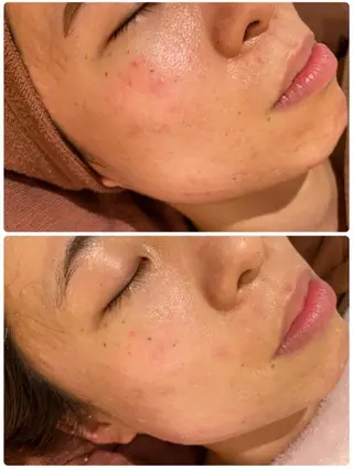 ニキビ跡改善専門🔥 医療にはできない改善のエステ・リラクイメージ