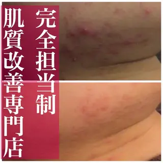 夏までに肌荒れ卒業 するサロン🌻のエステ・リラクイメージ