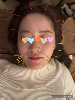 Acupuncture  salon LINOA リノア鍼灸院所属・LINOAヘッドスパ 小顔ケア/逆子ケアのエステ・リラクイメージ