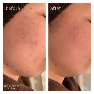 ミディアム カラー パーマ ヘアアレンジ メンズ キッズ ネイル マツエク・マツパ ニキビ跡専門サロン Ａｉｎａのエステ・リラクイメージ