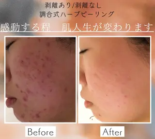 ニキビ/肌質改善専門 Snow skinのエステ・リラクイメージ