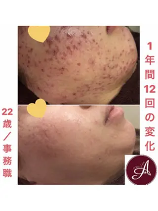 ショート カラー パーマ ヘアアレンジ メンズ キッズ ネイル マツエク・マツパ ニキビ・肌質改善専門 ♡人生が変わるサロンのエステ・リラクイメージ