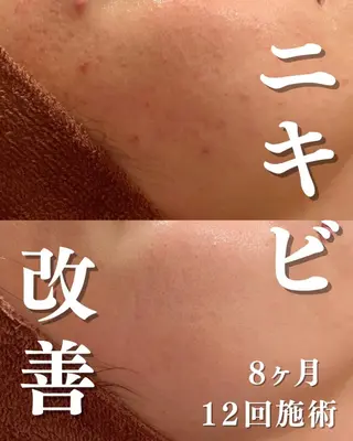🔥3か月で肌革命 🔥ニキビ専門店のエステ・リラクイメージ
