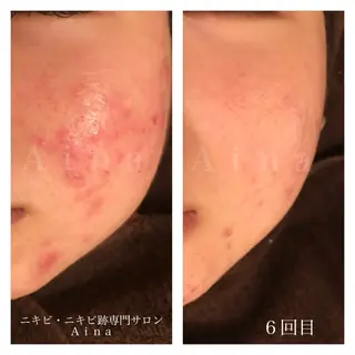 ニキビ跡専門サロン Ａｉｎａのエステ・リラクイメージ