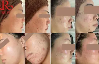 中目黒ハーブピーリン グ🌿ララピールのエステ・リラクイメージ