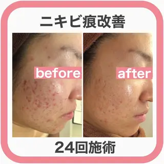 セミロング カラー パーマ ヘアアレンジ メンズ ネイル マツエク・マツパ アイブロウ 🔥3か月で肌革命 🔥ニキビ専門店のエステ・リラクイメージ