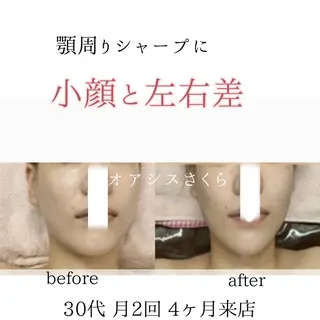 オアシス・さくら所属・小顔（シミ ニキビ）脱毛サロンのエステ・リラクイメージ