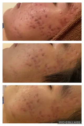 ニキビ特化型エステ 🍓最短で肌質改善のエステ・リラクイメージ