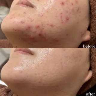 mieux所属・ハーブピーリング ¥6600のエステ・リラクイメージ