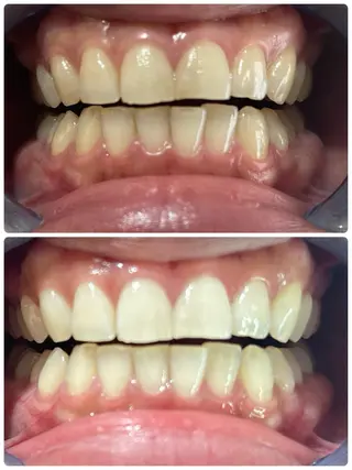 歯のセルフホワイトニング専門店GLOW（グロウ）所属・東区香椎歯のセルフホ ワイトニングGLOWのその他イメージ