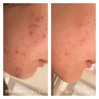 ミディアム カラー パーマ ヘアアレンジ メンズ キッズ ネイル マツエク・マツパ ニキビ跡専門サロン Ainaのエステ・リラクイメージ