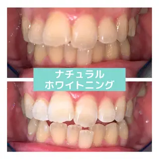 ホワイトニング｜韓国式3D毛穴洗浄 lonhana ﾛﾝﾊﾅ所属・韓国式3D毛穴洗浄 lonhanaのその他イメージ