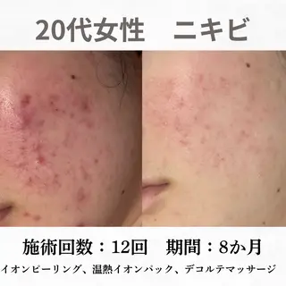 重度ニキビ専門🌷 ダウンタイムなしのエステ・リラクイメージ