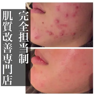 ミディアム カラー パーマ ヘアアレンジ メンズ キッズ ネイル マツエク・マツパ ニキビ・肌質改善専門 ♡人生が変わるサロンのエステ・リラクイメージ