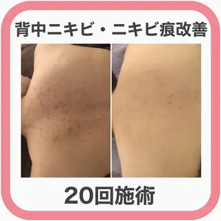 ニキビ跡改善専門🔥 医療にはできない改善のエステ・リラクイメージ