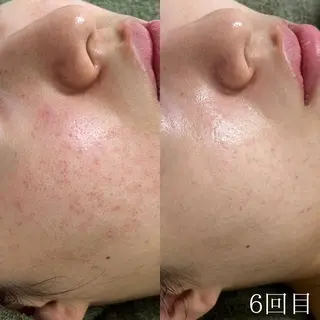 韓国美肌/肌質改善 【天神】yuiのエステ・リラクイメージ