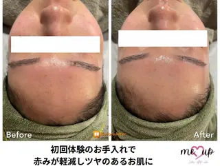 Meupニキビ専門店 背中/ハーブ/肌管理のその他イメージ