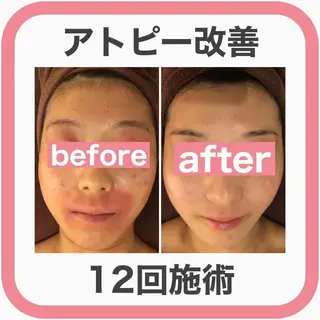 ニキビ跡改善専門🔥 医療にはできない改善のエステ・リラクイメージ