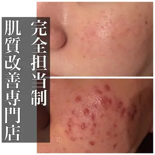 ミディアム カラー パーマ ヘアアレンジ メンズ キッズ ネイル マツエク・マツパ ニキビ・肌質改善専門 ♡人生が変わるサロンのエステ・リラクイメージ