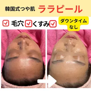 韓国肌&ララピール シミケア　せんすのエステ・リラクイメージ