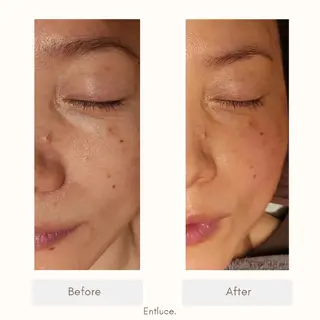 即効⚡小顔美容鍼🪡 むくみたるみ脂肪解消のエステ・リラクイメージ