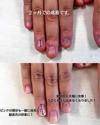 ネイル 深爪矯正・自爪育成 ヴェールリムのネイルデザイン