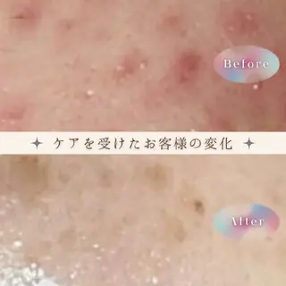 エイジングケアサロンBIOEL所属・肌質改善BIOELプ ラズマ/ラミピールのエステ・リラクイメージ
