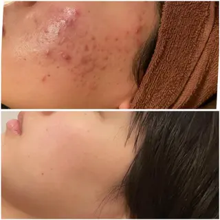 学生ニキビ改善🍀 優しい肌質改善のエステ・リラクイメージ