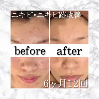 🔥3か月で肌革命 🔥ニキビ専門店のエステ・リラクイメージ