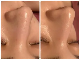 Chalon所属・REVI取扱・肌悩み 毛穴Chalonのエステ・リラクイメージ