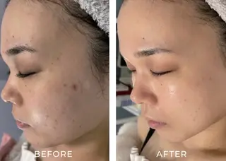 毛穴ケア くすみ肌 ハーブピーリングのエステ・リラクイメージ