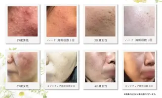 ニキビ&跡改善サロン オーナー光木のエステ・リラクイメージ