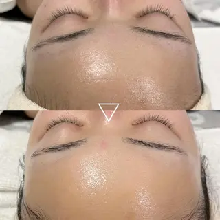 肌質改善＋小顔 🤍Kyrieのエステ・リラクイメージ