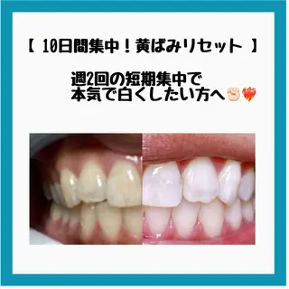 ネイル/耳つぼ /新ホワイトニングのネイルデザイン