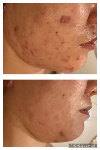 セミロング カラー パーマ ヘアアレンジ メンズ キッズ ネイル マツエク・マツパ アイブロウ ニキビ特化型エステ 🍓最短で肌質改善のエステ・リラクイメージ