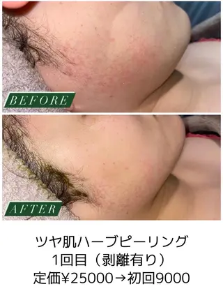 ハーブピーリング・毛穴ケア専門サロンSalon de LENA所属・ハーブピーリング 専門店/名古屋駅前店のその他イメージ