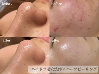 HINANO矢場町店【ヒナノ】所属・脱毛/肌改善🌿 HINANO 村田のエステ・リラクイメージ