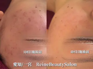 Reine BeautySalon所属・毛穴/シミ肝斑/脱毛 横山梨里のエステ・リラクイメージ