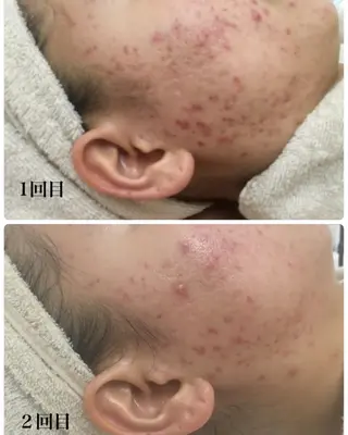 Meupニキビ専門店 背中/ハーブ/肌管理のその他イメージ