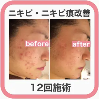 ニキビ跡改善専門🔥 医療にはできない改善のエステ・リラクイメージ