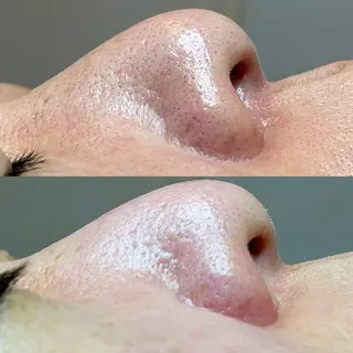 セルフエステエンリケ明石大久保店所属・夕希 毛穴と脱毛特化サロンのエステ・リラクイメージ