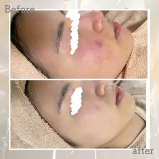 ニキビ&跡改善サロン オーナー光木のエステ・リラクイメージ