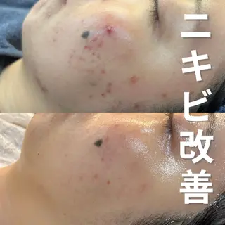 ニキビ・ニキビ跡改善 leoloのエステ・リラクイメージ