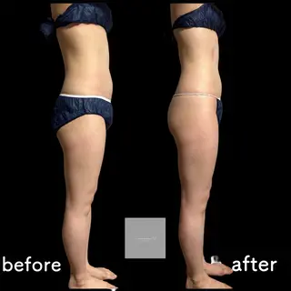 marron所属・痩身ハイパーナイフ ララピールリアボーテのエステ・リラクイメージ