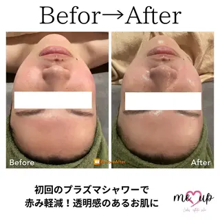 Meupニキビ専門店 背中/ハーブ/肌管理のその他イメージ