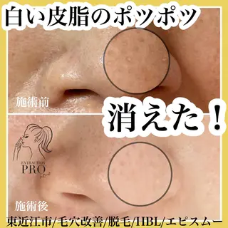 epismoo 脱毛/HBL/毛穴の眉毛・アイブロウイメージ