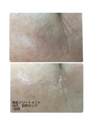 ハーブピーリング/韓国肌管理/フェイシャル/毛穴洗浄/眉毛/顔脱毛【糸脱毛専門】rev所属・ハーブピーリング🌹 毛穴洗浄❤️眉waxのエステ・リラクイメージ