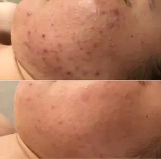 肌質改善/小顔/ ナスサロ/Yuiのエステ・リラクイメージ